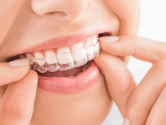 Clear Aligners London Ontario: What to Expect From Your Smile Straightening Journey
