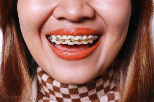 Waiting for Every Adult Tooth Before Braces Rarely Pays Off
